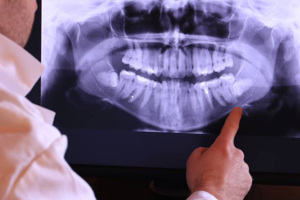 Best Emergency Wisdom Teeth Removal in Quinnesec, MI