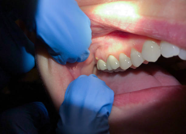 Best Emergency Tooth Extraction in Quinnesec, MI